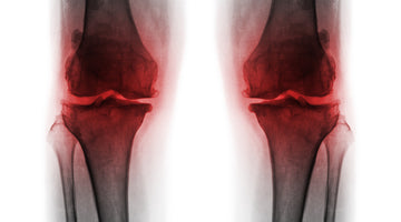 Faster Recovery After Total Knee Replacement Surgery with Red Light Therapy