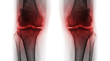 Faster Recovery After Total Knee Replacement Surgery, Light Therapy.