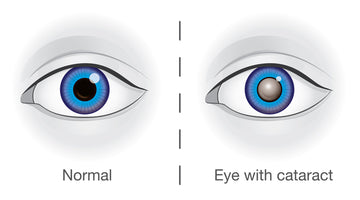 Illuminating Hope: Red Light Therapy and Cataracts