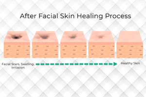 Red light therapy enhances healing after a classic facial.