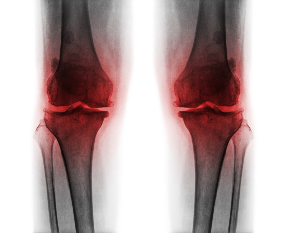 Faster Recovery After Total Knee Replacement Surgery, Light Therapy ...