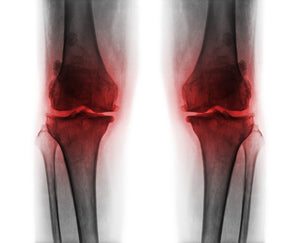 Faster Recovery After Total Knee Replacement Surgery with Red Light Therapy